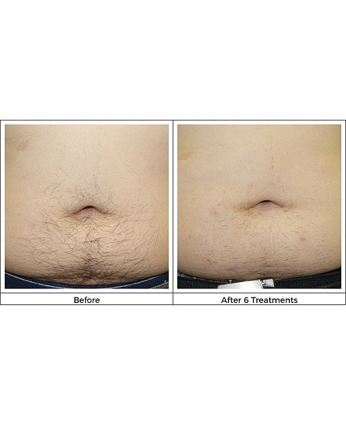 Silk N Infinity Hair Removal Device Reviews Tools Devices Beauty Macy S Not only does the brand promise that you will see up to 94 percent hair reduction in as little as three treatments, but it also comes with two. infinity hair removal device