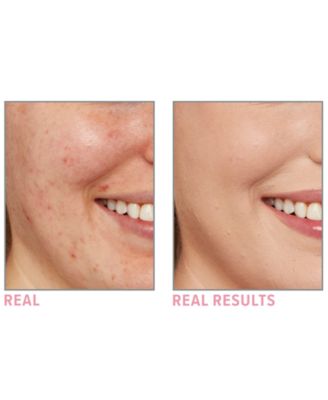 it cosmetics bye bye breakout